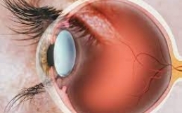 Glaucoma: Diagnosi e Nuove strategie terapeutiche