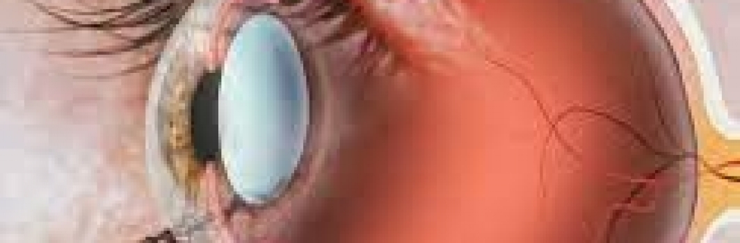 Glaucoma: Diagnosi e Nuove strategie terapeutiche